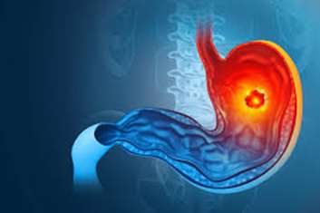 مطالعه فاز II راندوم‌شده CAR‑T سلول بند Claudin18.2 (Satri‑cel) در سرطان معده/معده‌معده‌مری منتشر شد